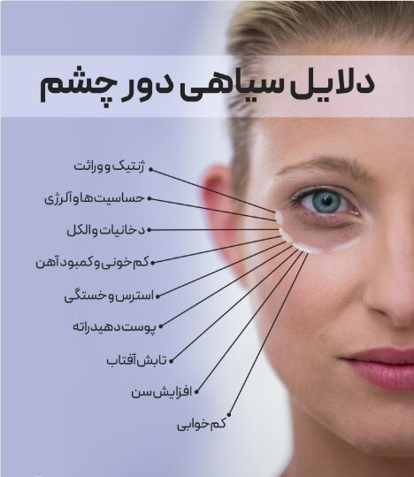 چرا دور چشممان تیره می‌شود؟ بررسی جامع دلایل سیاهی و گودی زیر چشم
